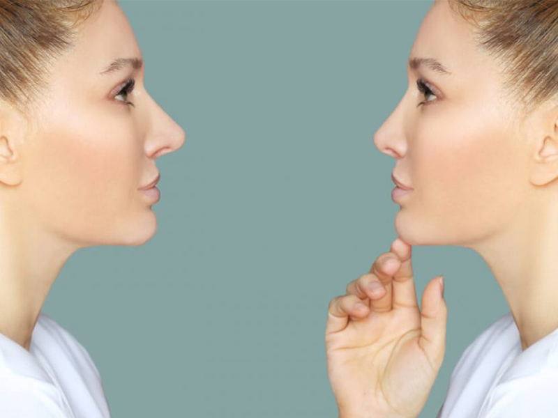 قبل از جراحی بینی چه اقداماتی باید انجام داد؟