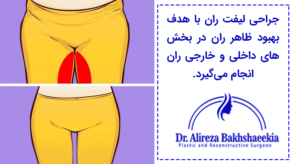 لیفت ران مزایا