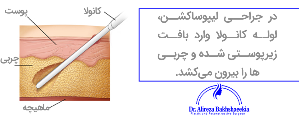 نحوه لیپوساکشن