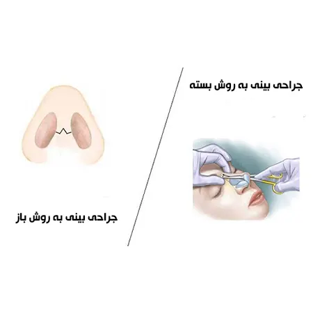 انواع روش جراحی بینی