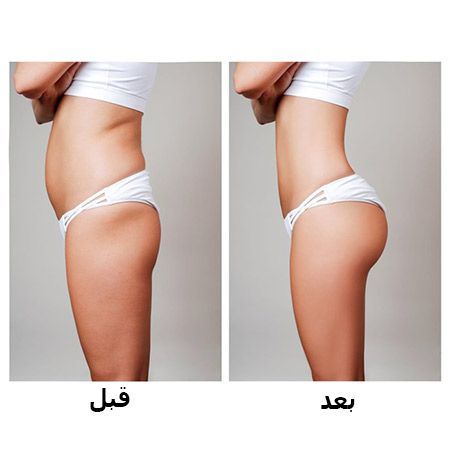 پروتز باسن