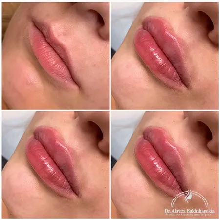 تزریق ژل به لب