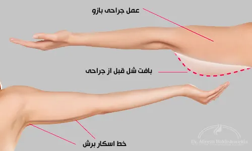 جراحی لیفت بازو