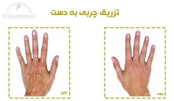 تزریق چربی به دست