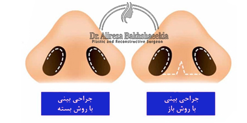تفاوت جراحی بینی به روش باز و بسته