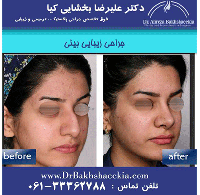جراحی-بینی-باز