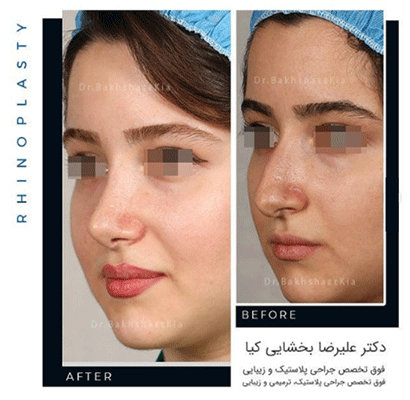 جراحی-بینی-عروسکی